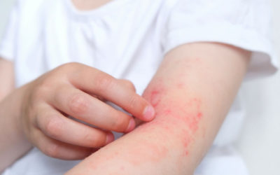 La Dermatitis Atópica: segunda causa de visita al dermatólogo a nivel nacional